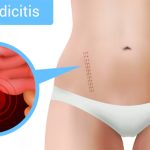 Signs You Might be Suffering From Appendicitis