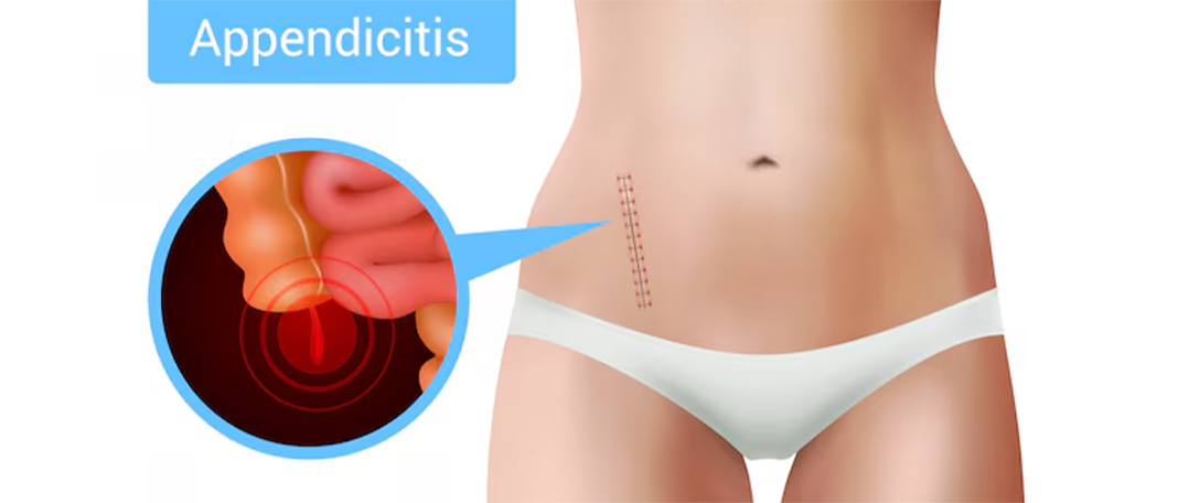 Signs You Might be Suffering From Appendicitis
