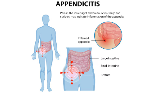 Signs and symptoms of Appendicitis