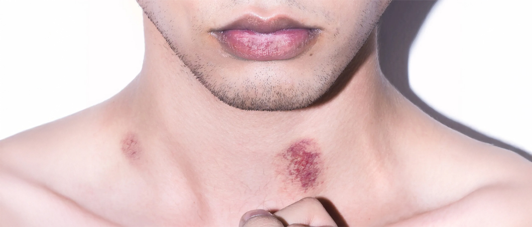 8 Ways to Grid of Hickies Almost Instantly