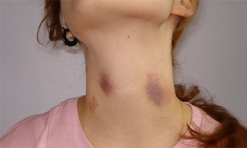 hickies