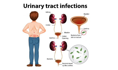 FAQs About Urinary Tract Infections