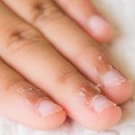 Peeling Cuticles : How To Treat, Home Remedies, Why it occur