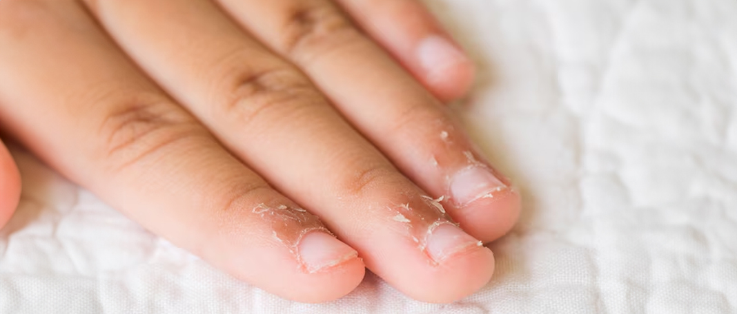 Peeling Cuticles : How To Treat, Home Remedies, Why it occur