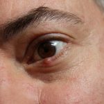 5 Ways to get rid of a Stye