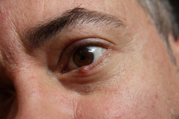 5 Ways to get rid of a Stye