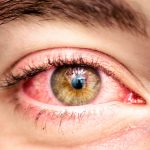 Conjunctivitis Guide: Symptoms, Types & Home Care