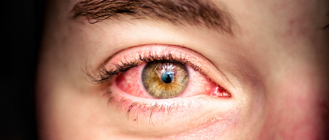 Conjunctivitis Guide: Symptoms, Types & Home Care
