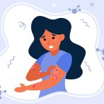 Symptoms and Treatments of Measles