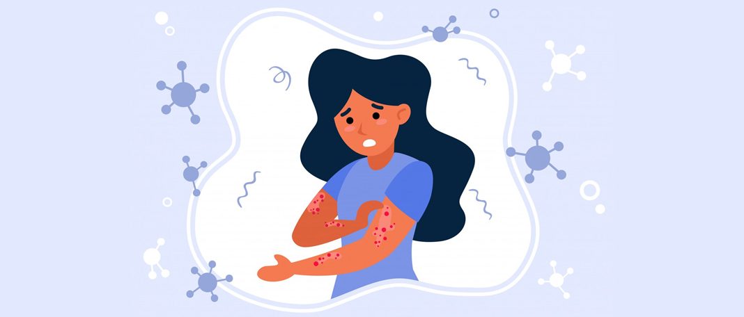Symptoms and Treatments of Measles