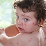 Chickenpox : Symptoms, Causes, Treatment and How to prevent
