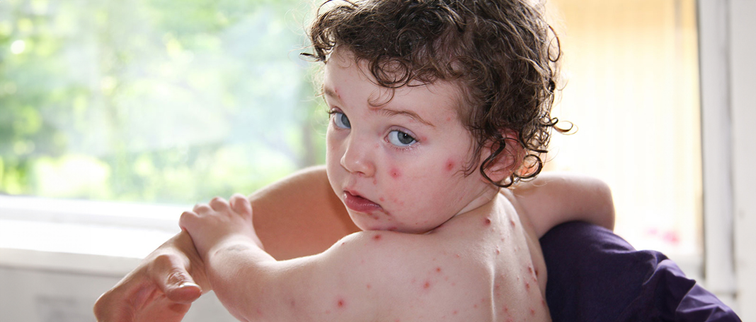 Chickenpox : Symptoms, Causes, Treatment and How to prevent
