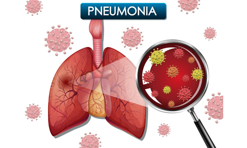 Pneumonia