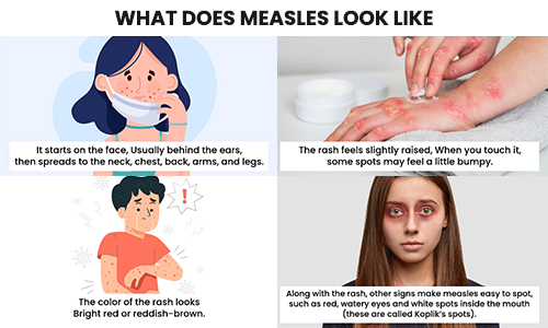 What Does Measles Look Like