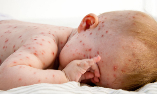 Chickenpox-Symptoms