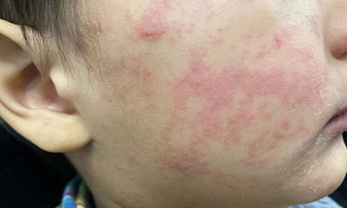 What-Does-Measles-Look-Like