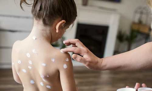 Chickenpox-Treatment