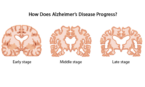 How-Does-Alzheimer’s-Disease-Progress