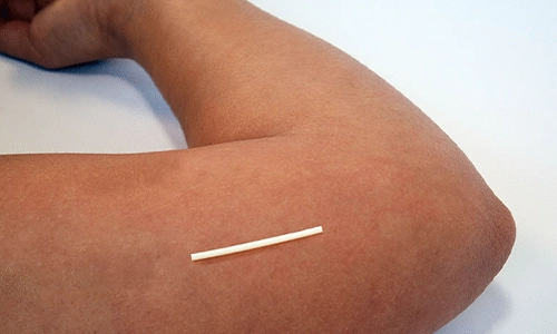 Contraceptive Implants