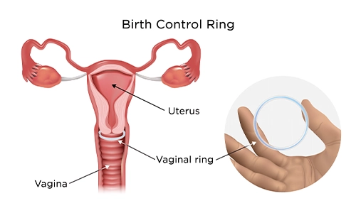 Vaginal Ring