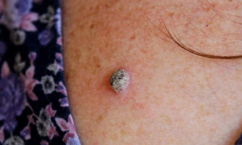 Wart