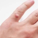 How to Get Rid of a Wart Fast and Painless