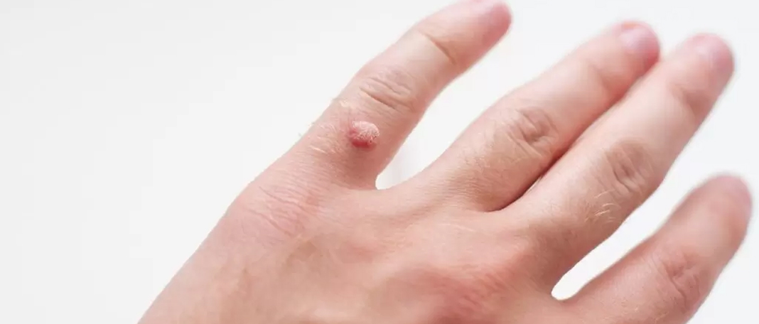 How to Get Rid of a Wart Fast and Painless