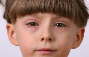 conjunctivitis_456px
