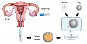 ivf