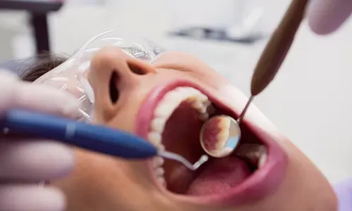 Impacted Wisdom Teeth