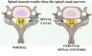 Cervical stenosis