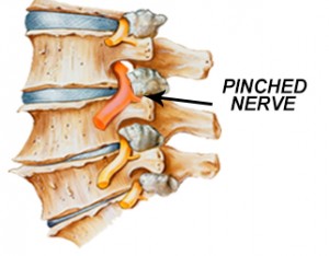Pinched nerve
