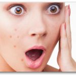 6 Tips that will help treat your acne