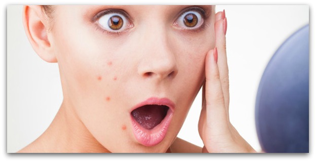 6 Tips that will help treat your acne