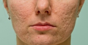 scars caused by acnes