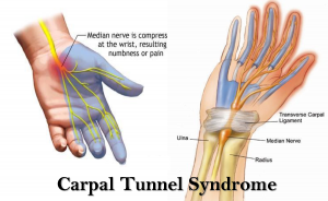 carpel tunnel syndrome