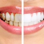 6 Foods that prevent gum disease