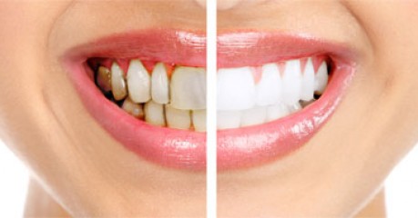 6 Foods that prevent gum disease