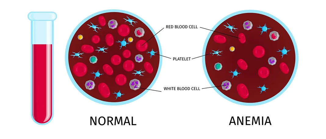 7 Signs of Anemia You Should Never Ignore Early