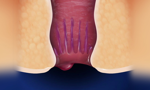 What-Are-Hemorrhoids