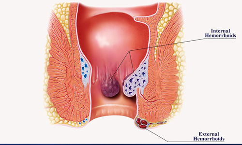 What-Does-Hemorrhoids-Look-Like