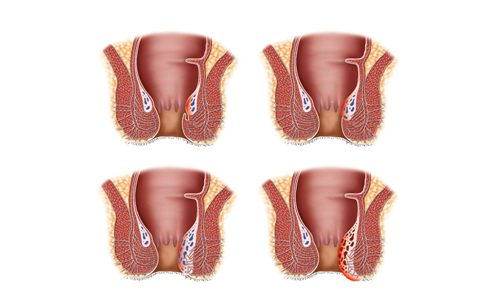 Stages-of-Hemorrhoids
