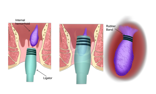 Rubber-Band-Ligation