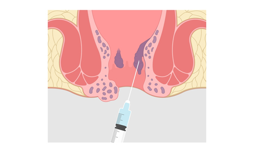 Sclerotherapy