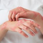 How to Treat Herpes Naturally – Herpes Blitz Protocol!