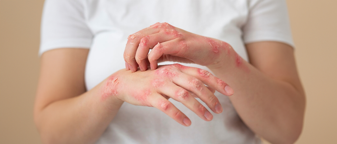 How to Treat Herpes Naturally – Herpes Blitz Protocol!