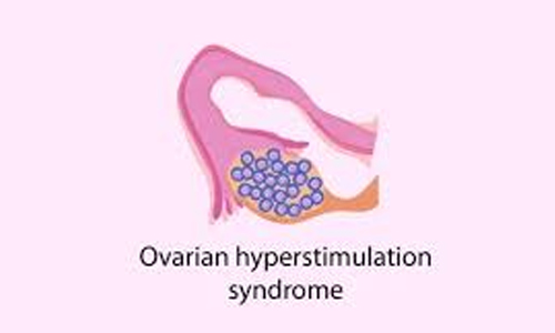 Ovarian-Hyperstimulation-Syndrome