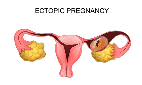 Ectopic-Pregnancy