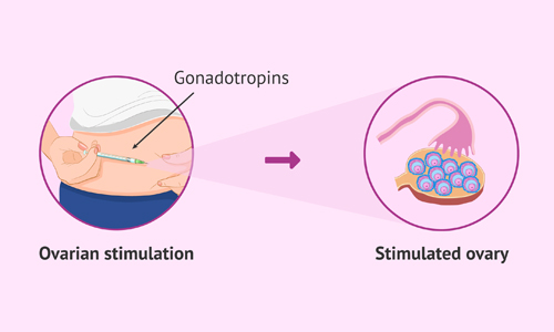 Ovarian-Stimulation