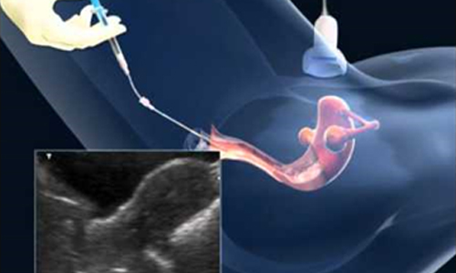 Embryo-Transfer